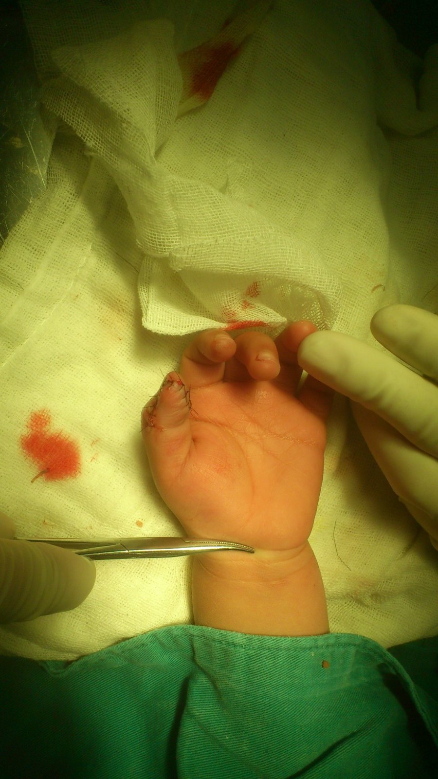 先天性拇指并指畸形治疗案例_先天性并指多指畸形_手术_治疗方式 - 好