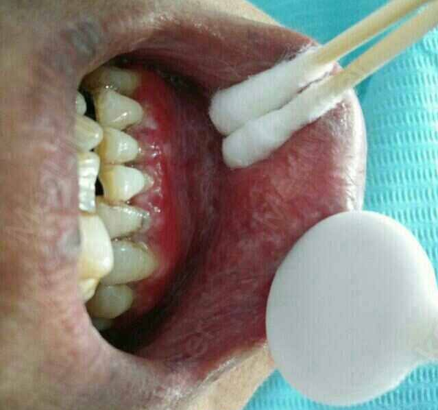 口腔扁平苔藓患者适宜多吃蔬菜