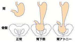 胃下垂 你还在四处乱投医吗 五个问题让你明明白白看病 胃下垂 疾病介绍 症状 治疗方法