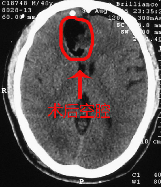 右侧单额开颅额叶胶质瘤切除