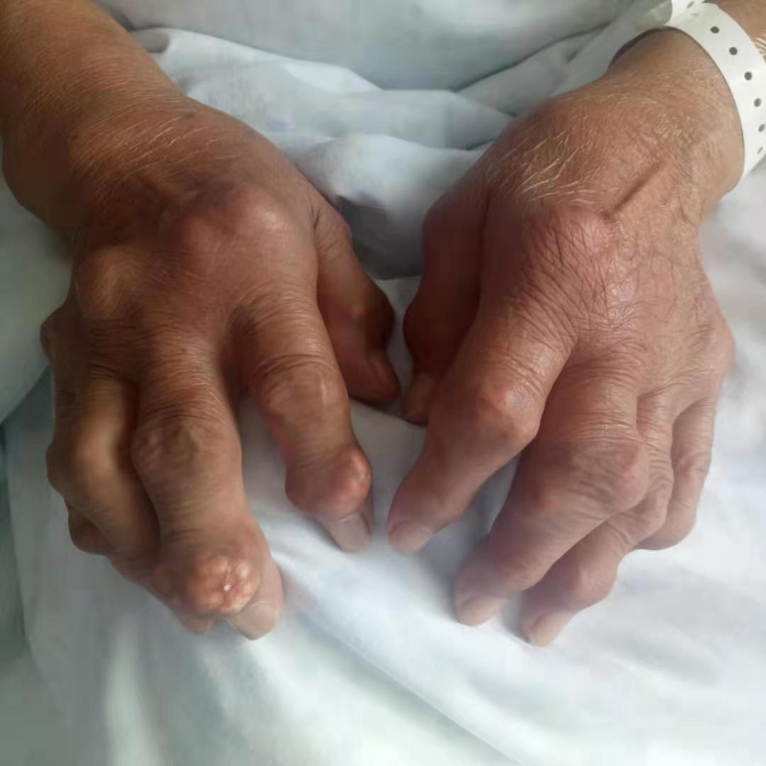 痛风性关节炎,您重视了吗? - 好大夫在线