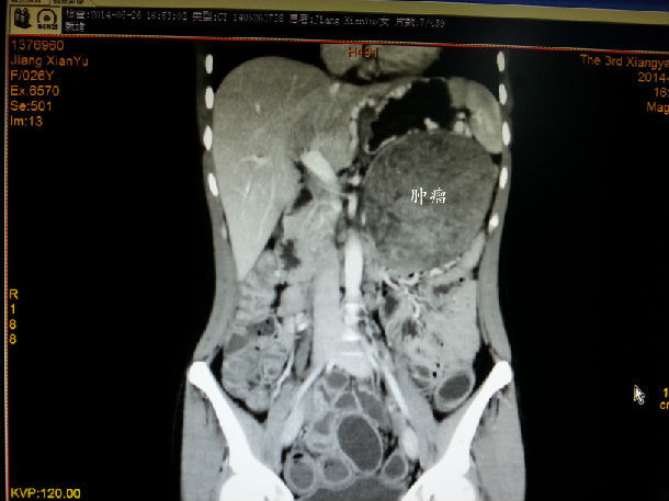 擅长:复杂肝、胆、胰腺肿瘤根治切除,手术切除率高。对肝硬化、脾肿大、顽固性腹水治疗及结肠癌...黄牛代挂联系方式-全天在门口随时联系,核磁加急办理的简单介绍 擅长:复杂肝、胆、胰腺肿瘤根治切除,手术切除率高。对肝硬化、脾肿大、顽固性腹水治疗及结肠癌...黄牛代挂联系方式-全天在门口随时联系,核磁加急办理的简单介绍