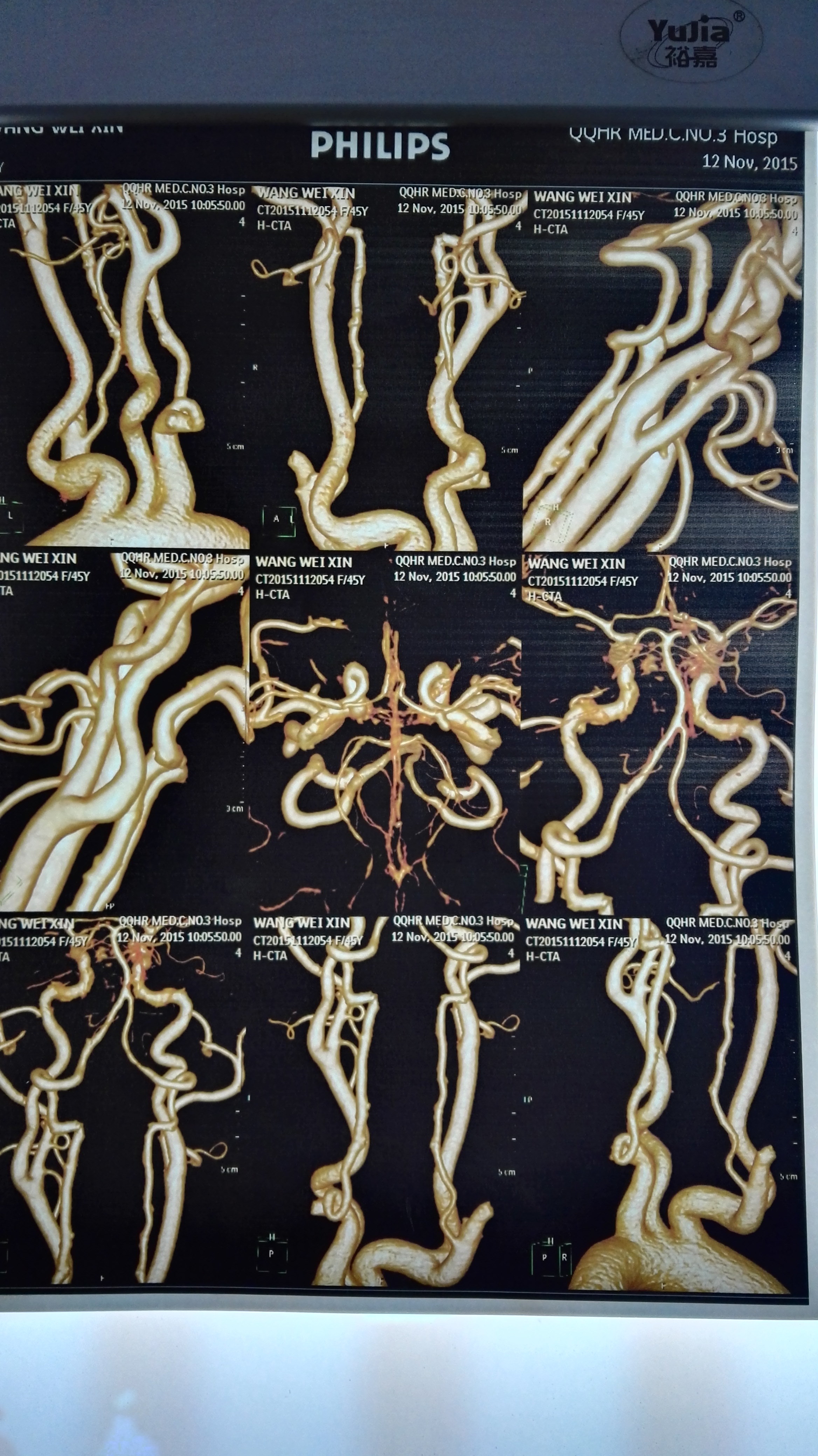 右侧大脑前动脉a1起始端动脉瘤,蛛网膜下腔出血 - 好大夫在线