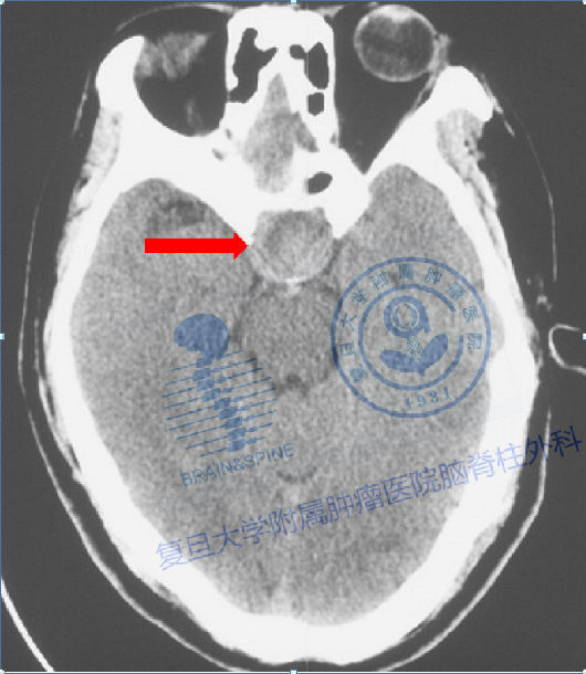 磁共振成像(mri):對垂體軟組織的分辨力優於ct,可彌補ct的不足;是術前