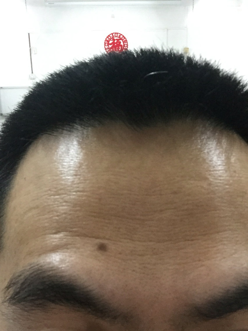 黑痦子红痦子能不恶变的都是好痦子