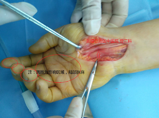 女性腕管综合征图片