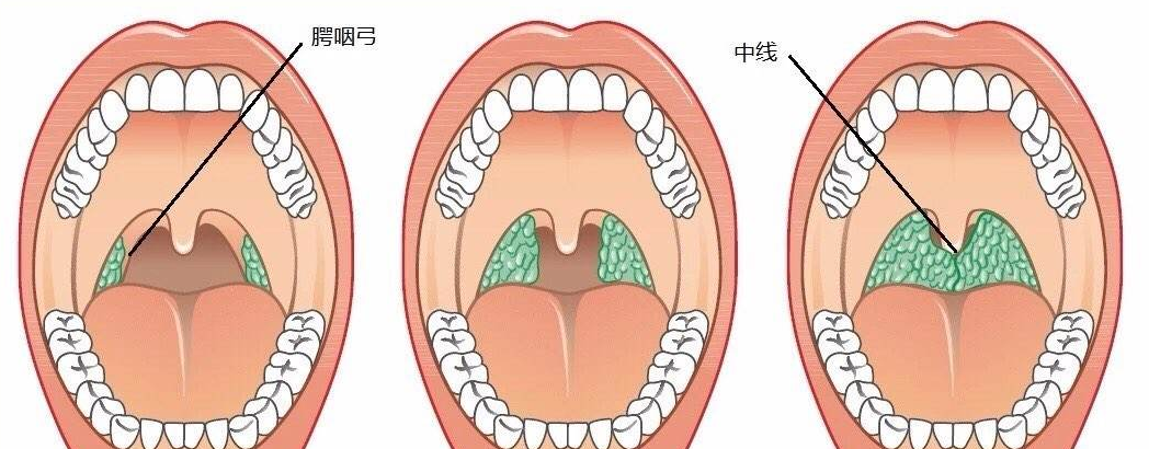 這個原理同口腔潰瘍和扁桃體,腺樣體腫大,都是因為空氣未被溼潤/加溫