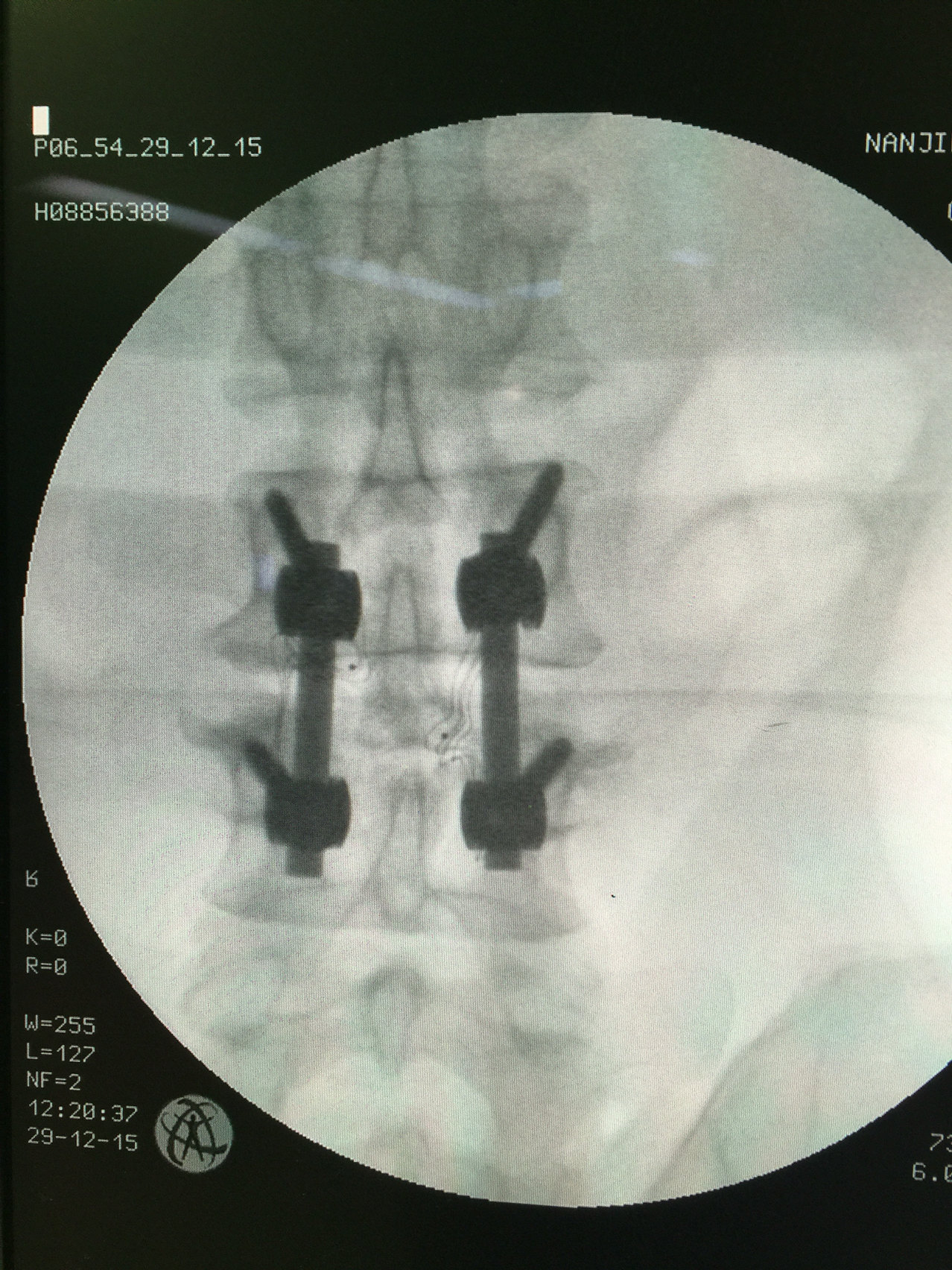 皮质骨螺钉,适合老年骨质疏松患者的新技术 - 好大夫在线