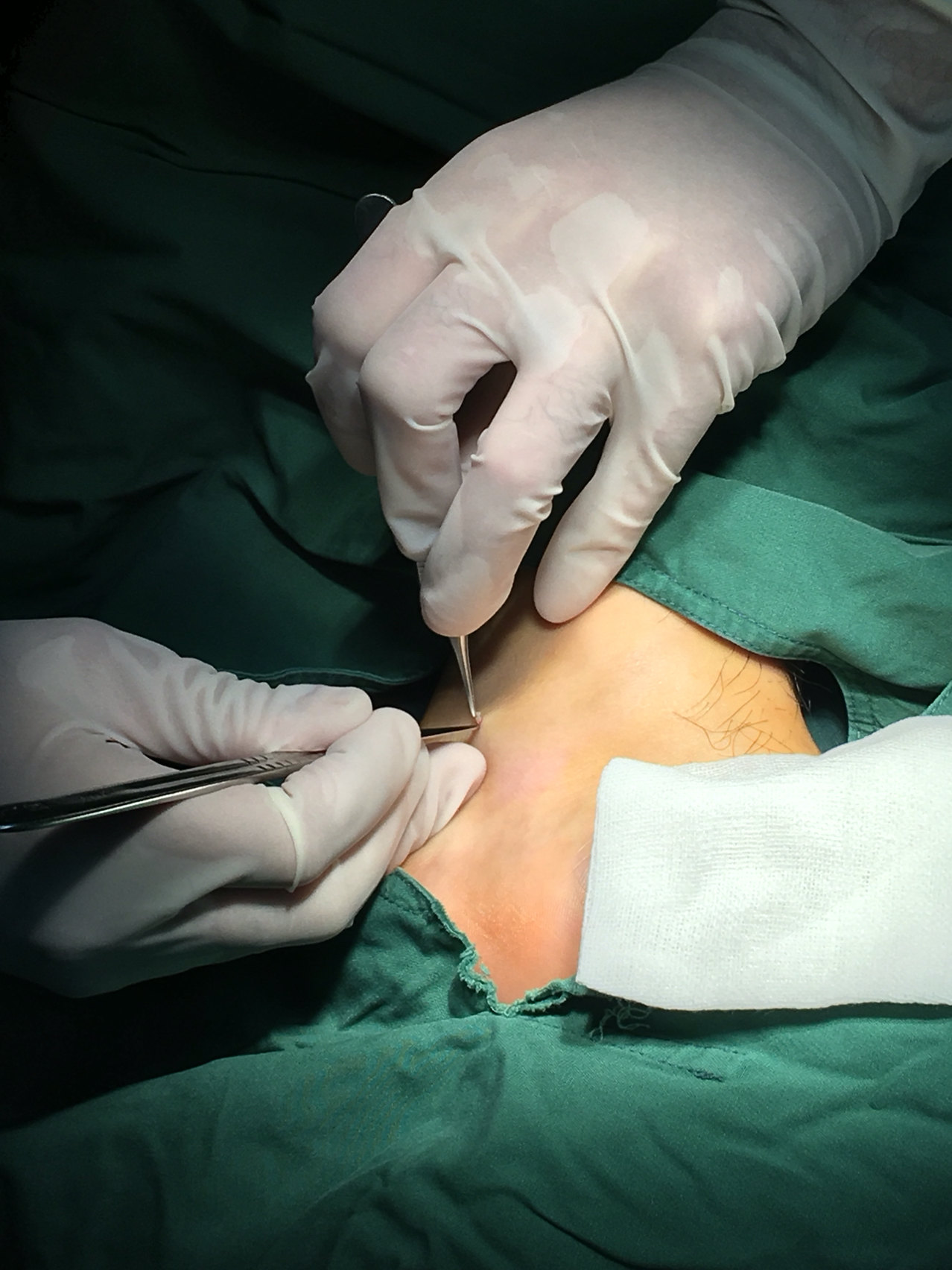 第一次自己给自己动手术 - 好大夫在线