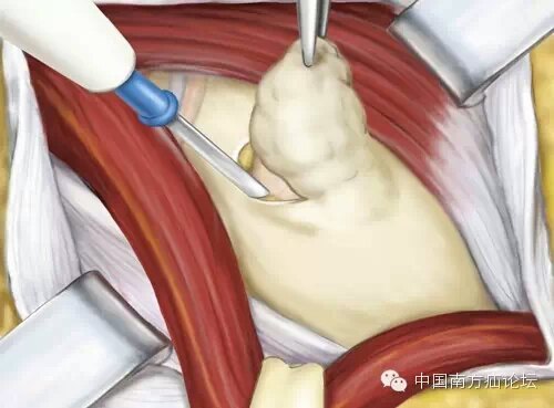 腹股沟疝的开放手术治疗(李金斯坦术式) 