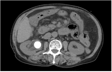 肾盂输尿管连接部梗阻继发肾结石的微创手术治疗