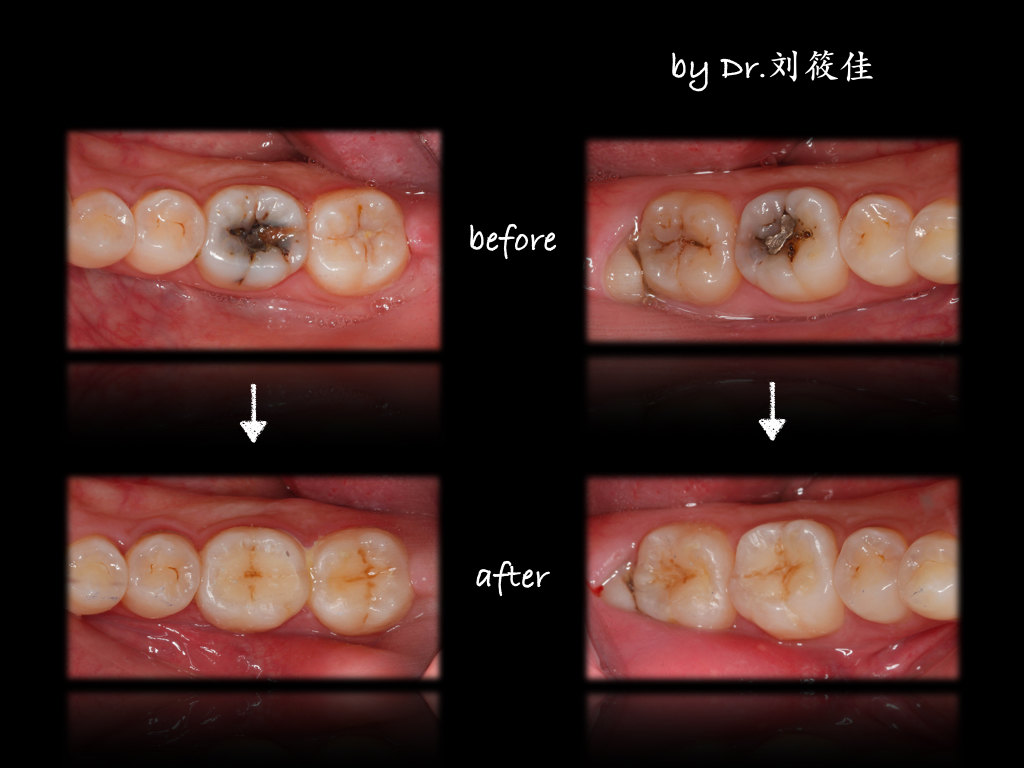 兒童齲病詳解