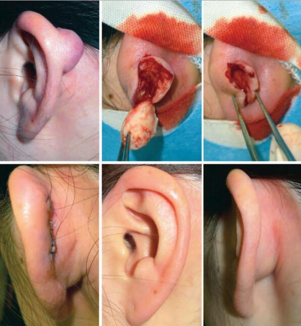 耳廓瘢痕疙瘩怎么治疗