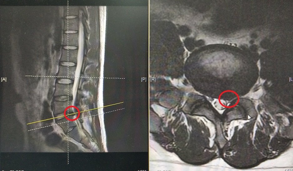 腰椎mri提示:l5-s1椎間盤偏左側突出,壓迫左側神經根(下圖mri中紅色圈