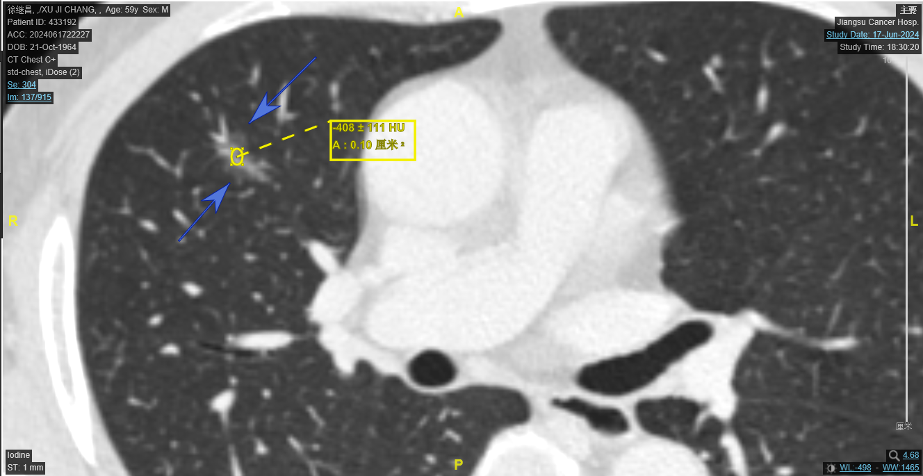 肿瘤放大图CT值.png