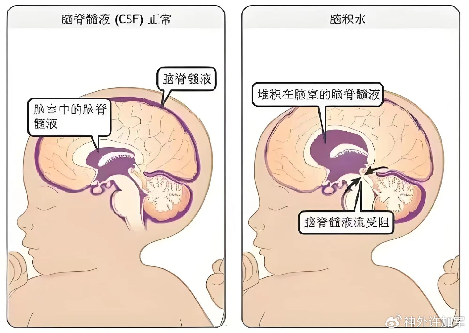 婴儿脑积水有哪些症状图片