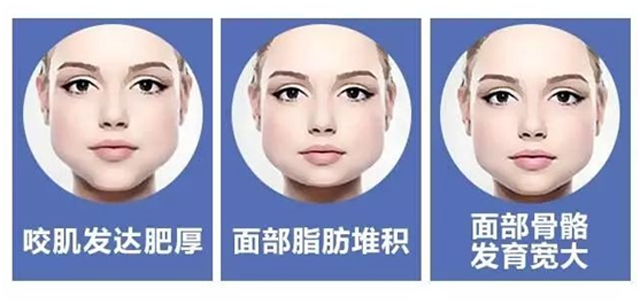 面部吸脂实现瘦脸和年轻化双功效_面部吸脂_面部吸脂治疗介绍 - 好