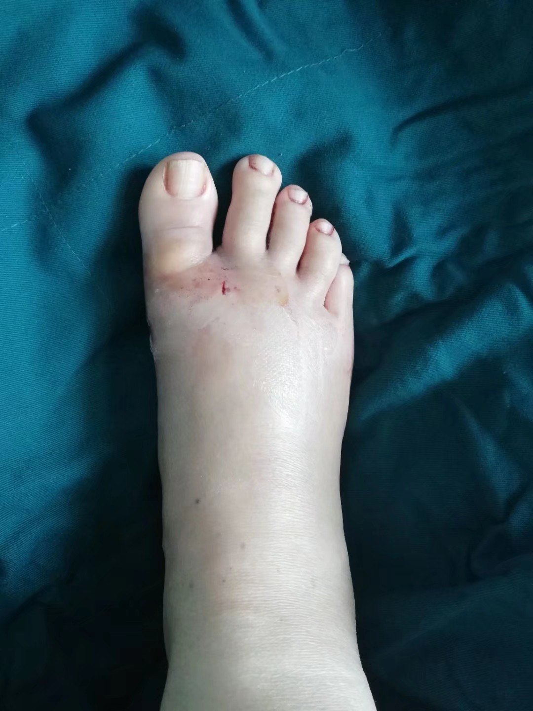 改良小切口拇外翻的病例 - 好大夫在线