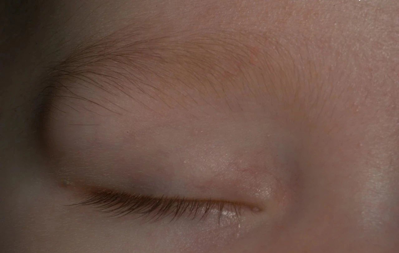 婴儿眉骨囊肿图片图片