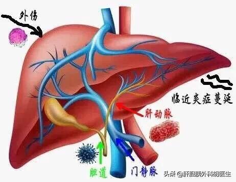 肝膿腫最常用的治療方式為b超或ct引導下膿腫穿刺引流,再配合細菌培養