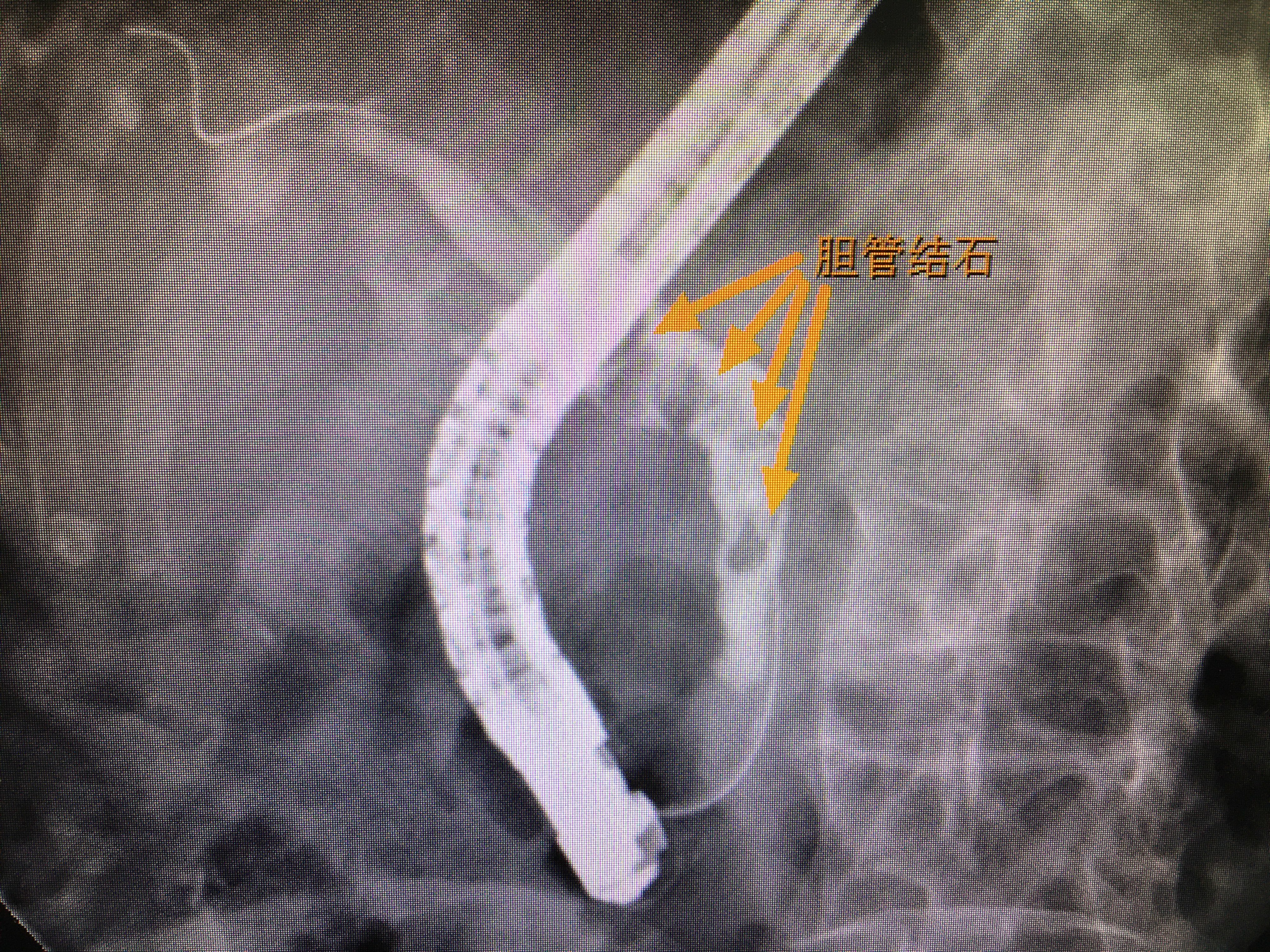 无法做核磁共振的胆管炎患者如何处理?
