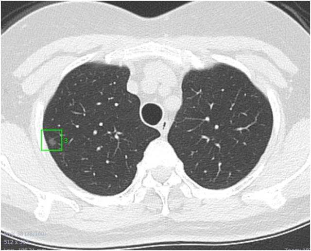 肺部结节 肺部结节