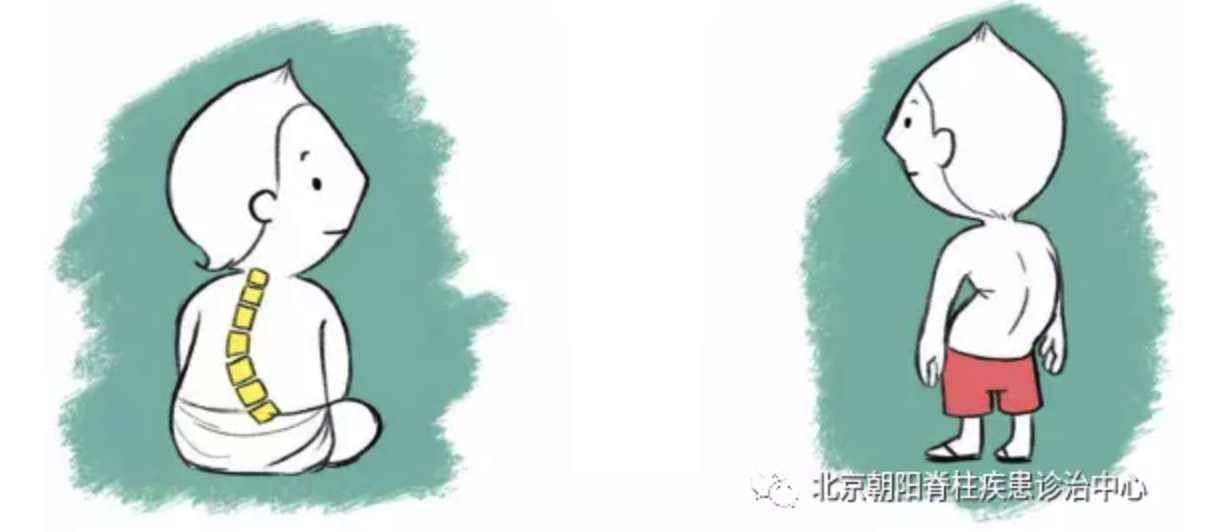 脊柱侧凸的儿童会出现背部弯曲,甚至表现为腰部,肩部和/或肩胛骨凹凸