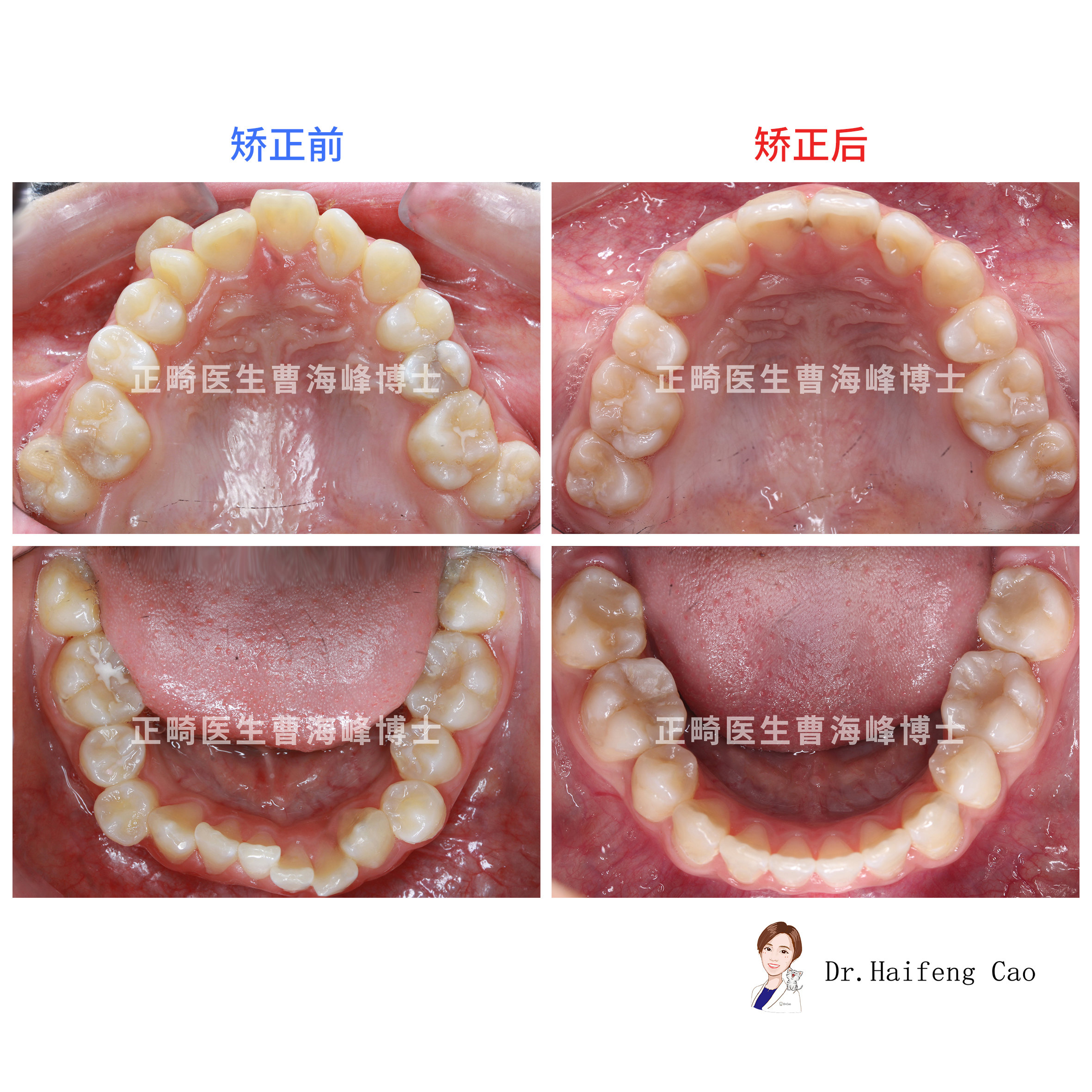 【牙齿拥挤,牙不齐矫正案例】