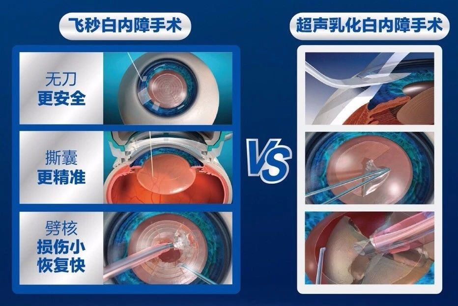 飞秒激光白内障手术