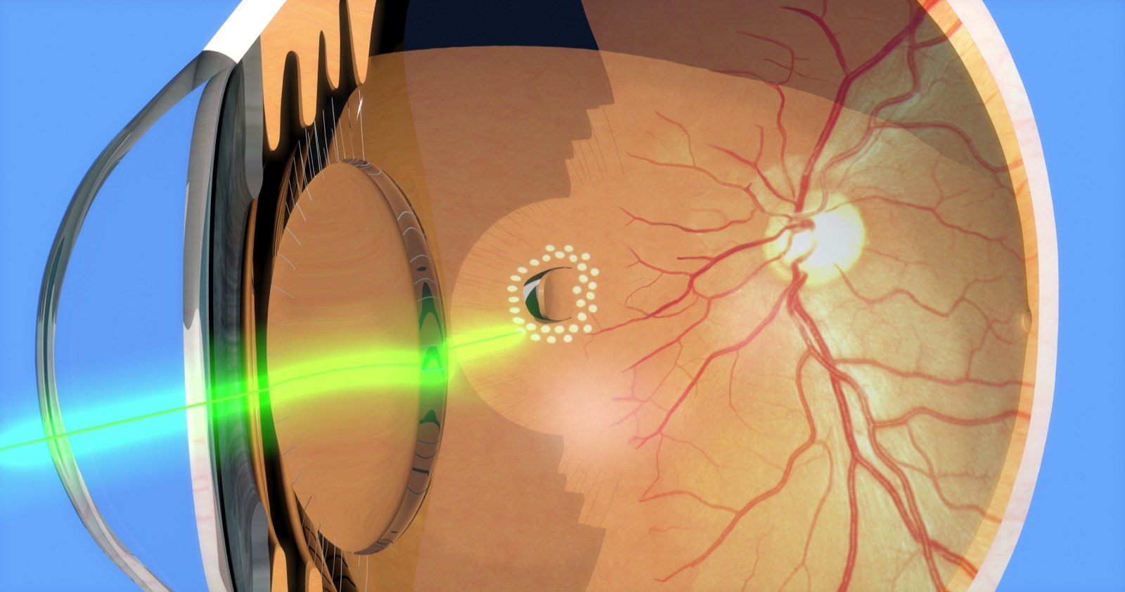视网膜裂孔激光图片