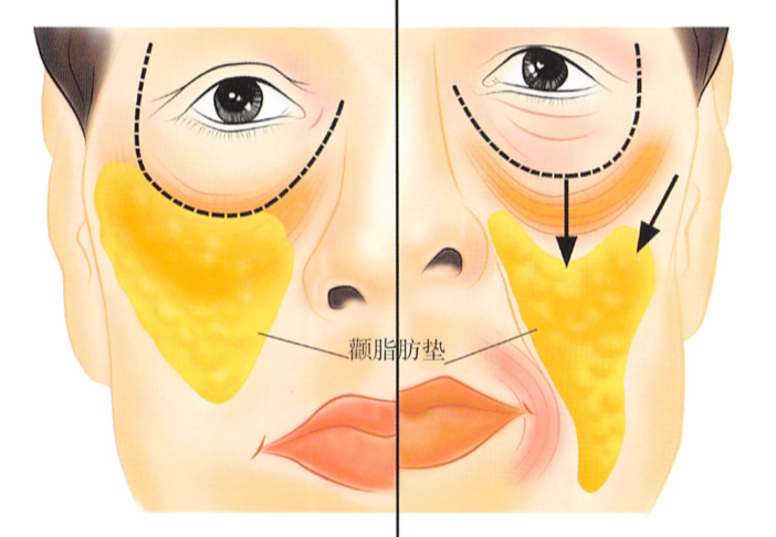 脂肪填充_脂肪填充治疗介绍 - 好大夫在线