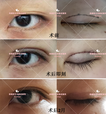 微创双眼皮与全切双眼皮的区别_双眼皮手术_双眼皮手术治疗介绍 - 好