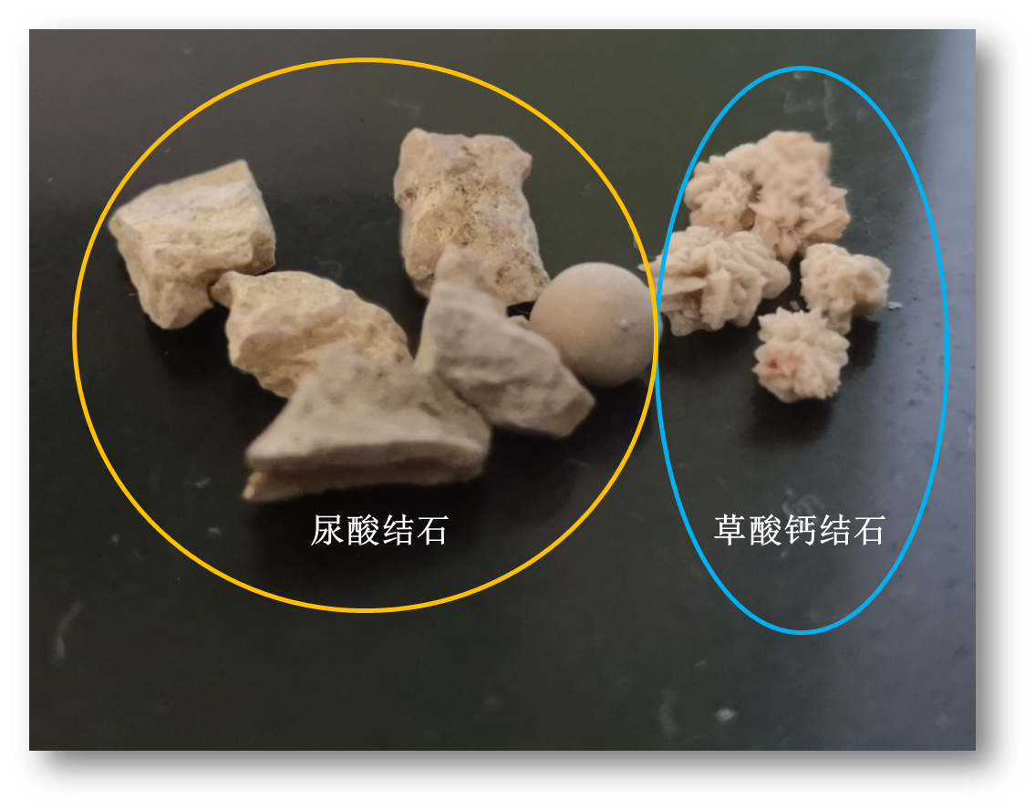 图5 尿酸结石和草酸钙结石外观作者:浙江大学医学院附属第一医院泌尿