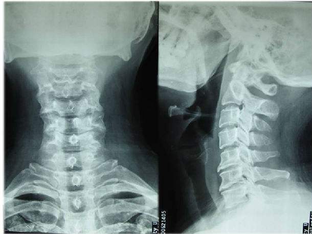 神经根受压情况动力位片过屈和过伸位,可以了解颈椎稳定性重要途径ct