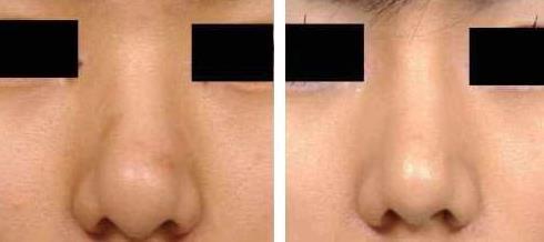 鼻头缩小为什么会导致增生?术后该如何避免?