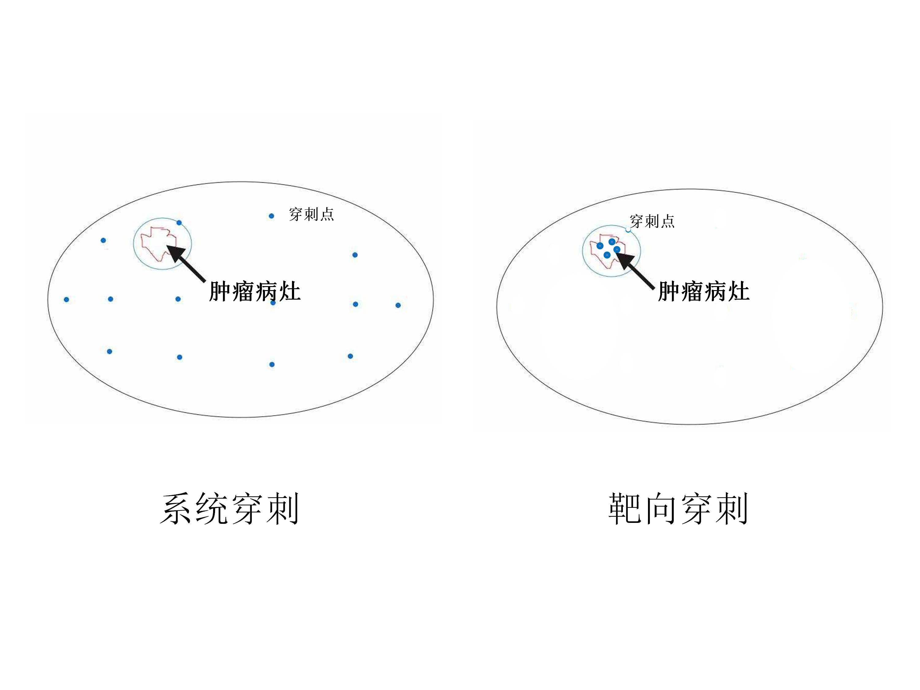 前列腺穿刺12点示意图图片