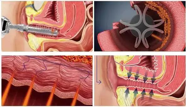 性器官整形 - 好大夫在线