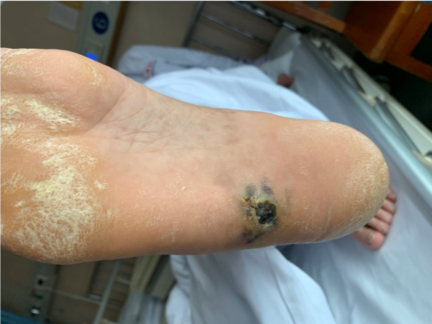 手和脚上的黑痣,一定要注意黑色素瘤!