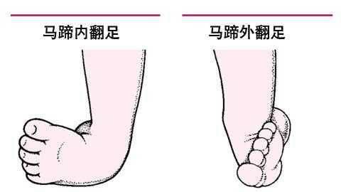 婴儿出现马蹄足症状怎么办?马蹄足能不能治疗好呢?