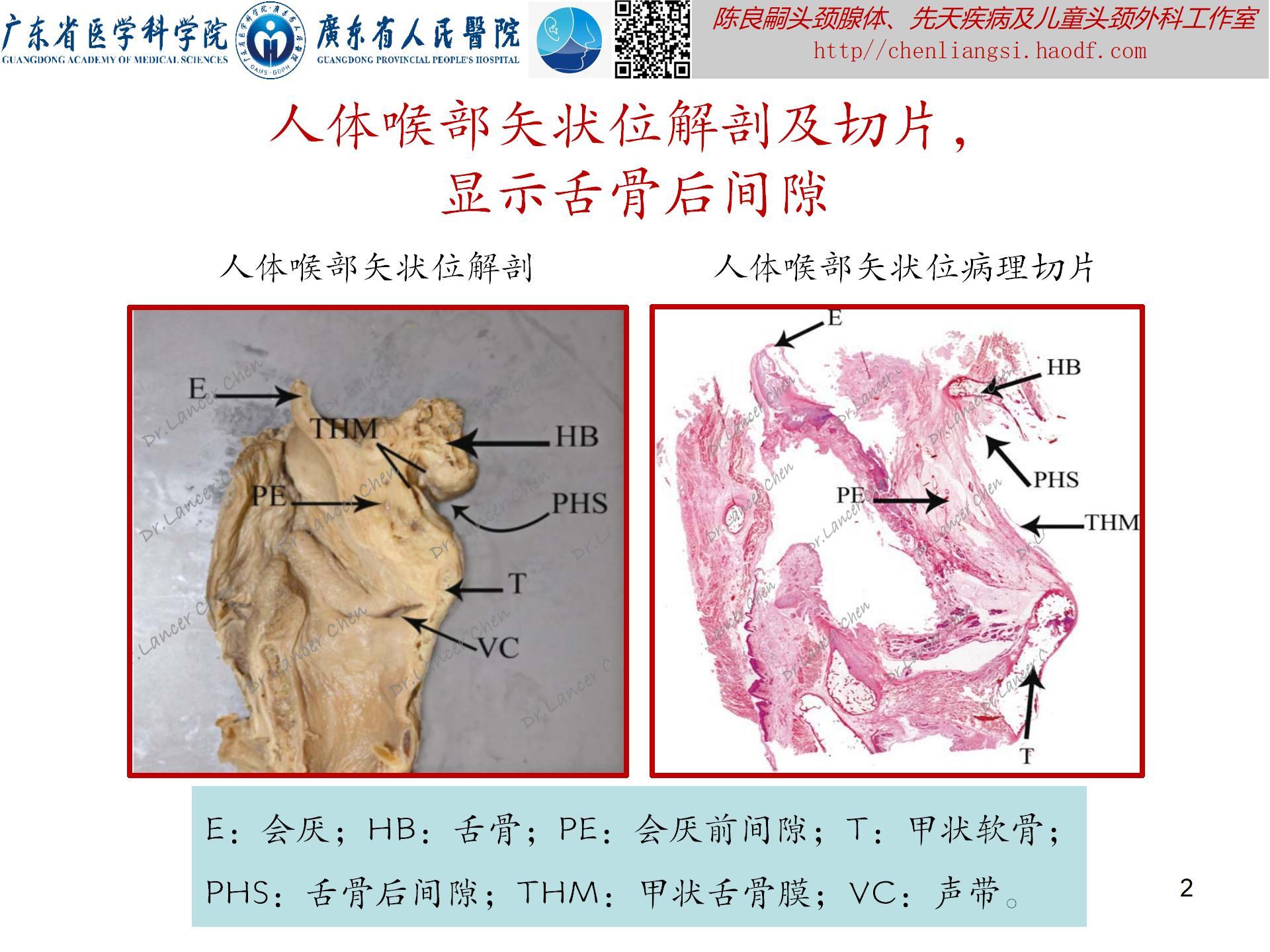 20240621：医学科普——百密一疏：舌骨后间隙的忽略，可导致甲状舌管囊肿术后复发_02.jpg