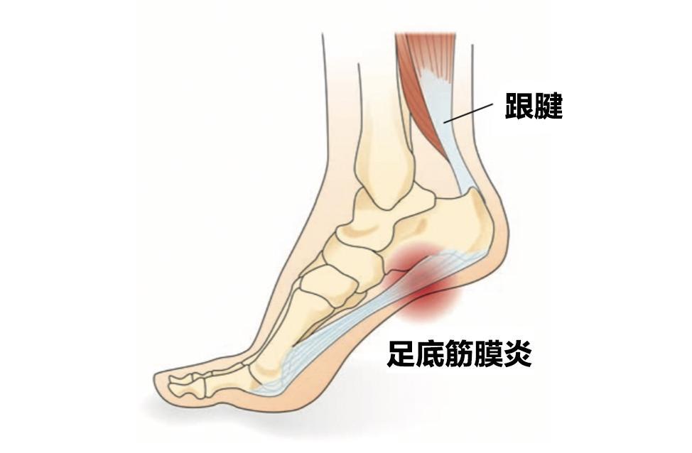 足底筋膜炎其实就是足底筋膜长时间受到刺激,产生的无菌性炎症