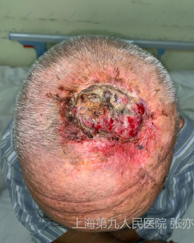 头皮鳞癌早期症状图片图片