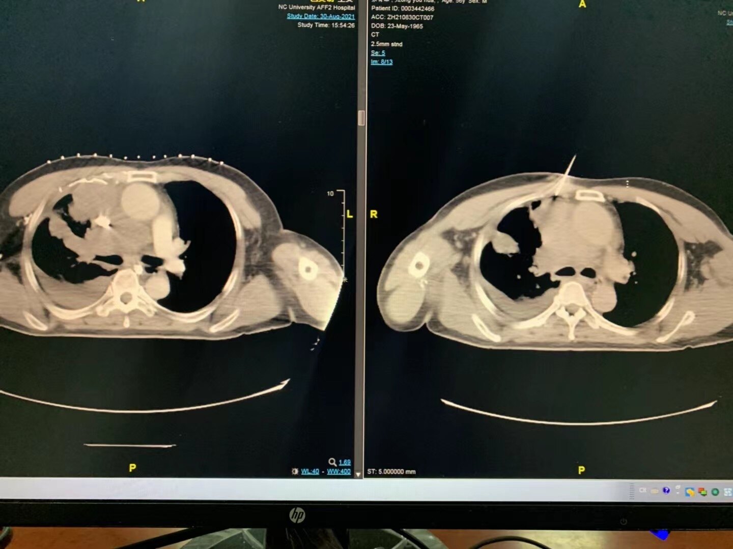 肺活检 - 好大夫在线