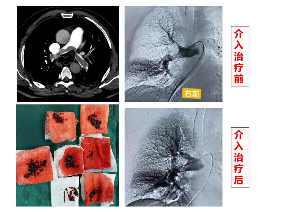 急性肺栓塞,慢性血栓栓塞性肺动脉高压的血管介入治疗 - 好大夫在线