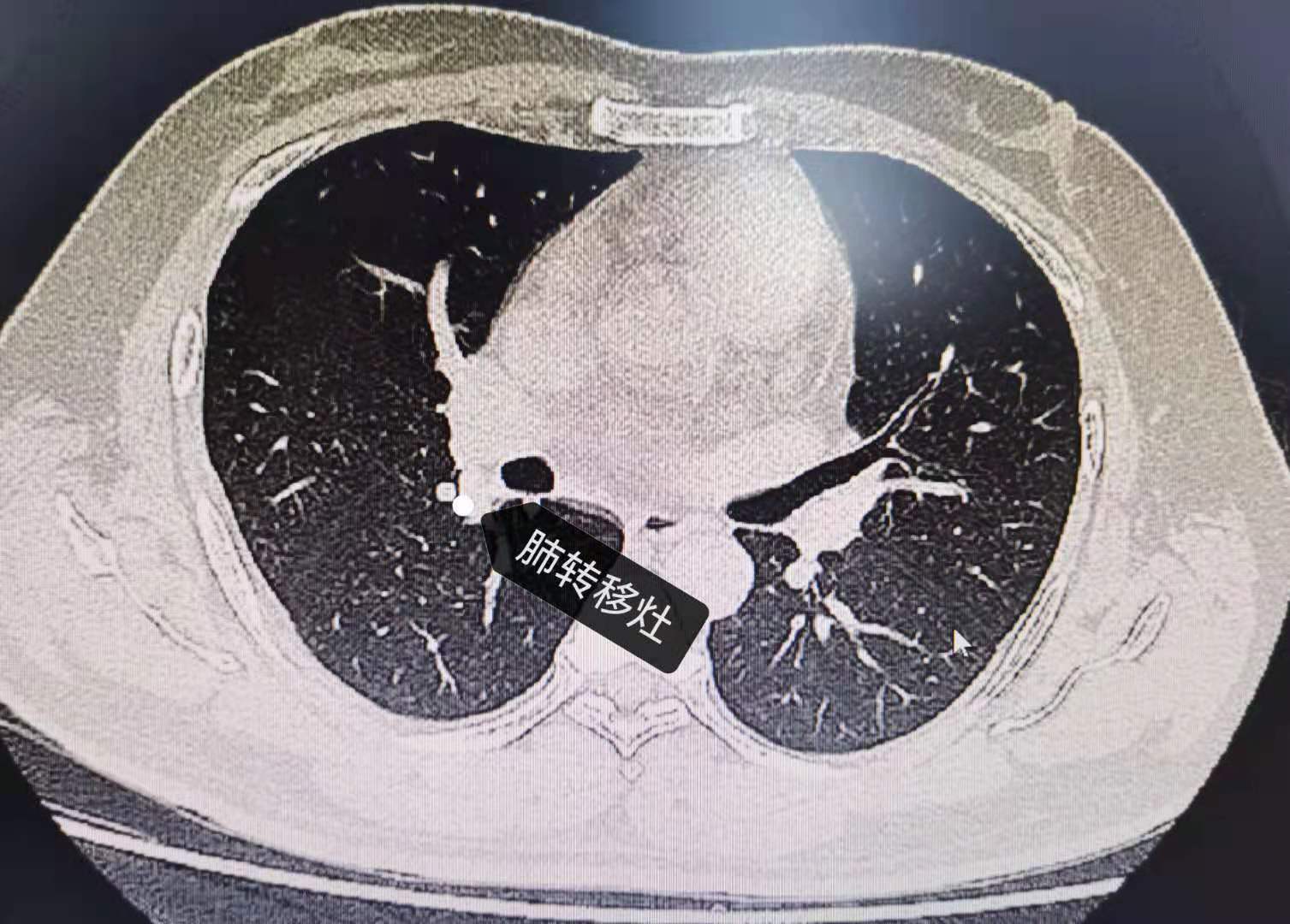 甲状腺癌伴双肺转移术后两年 - 好大夫在线