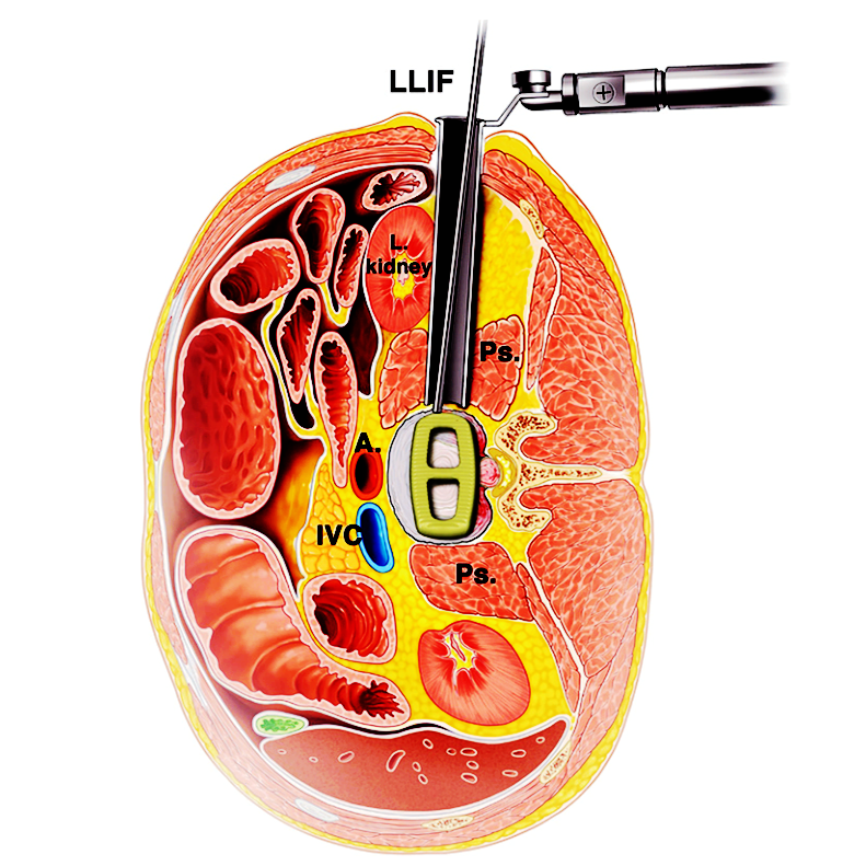 "俯卧位"llif手术:cadaver 可行性研究及早期临床经验 - 好大夫在线