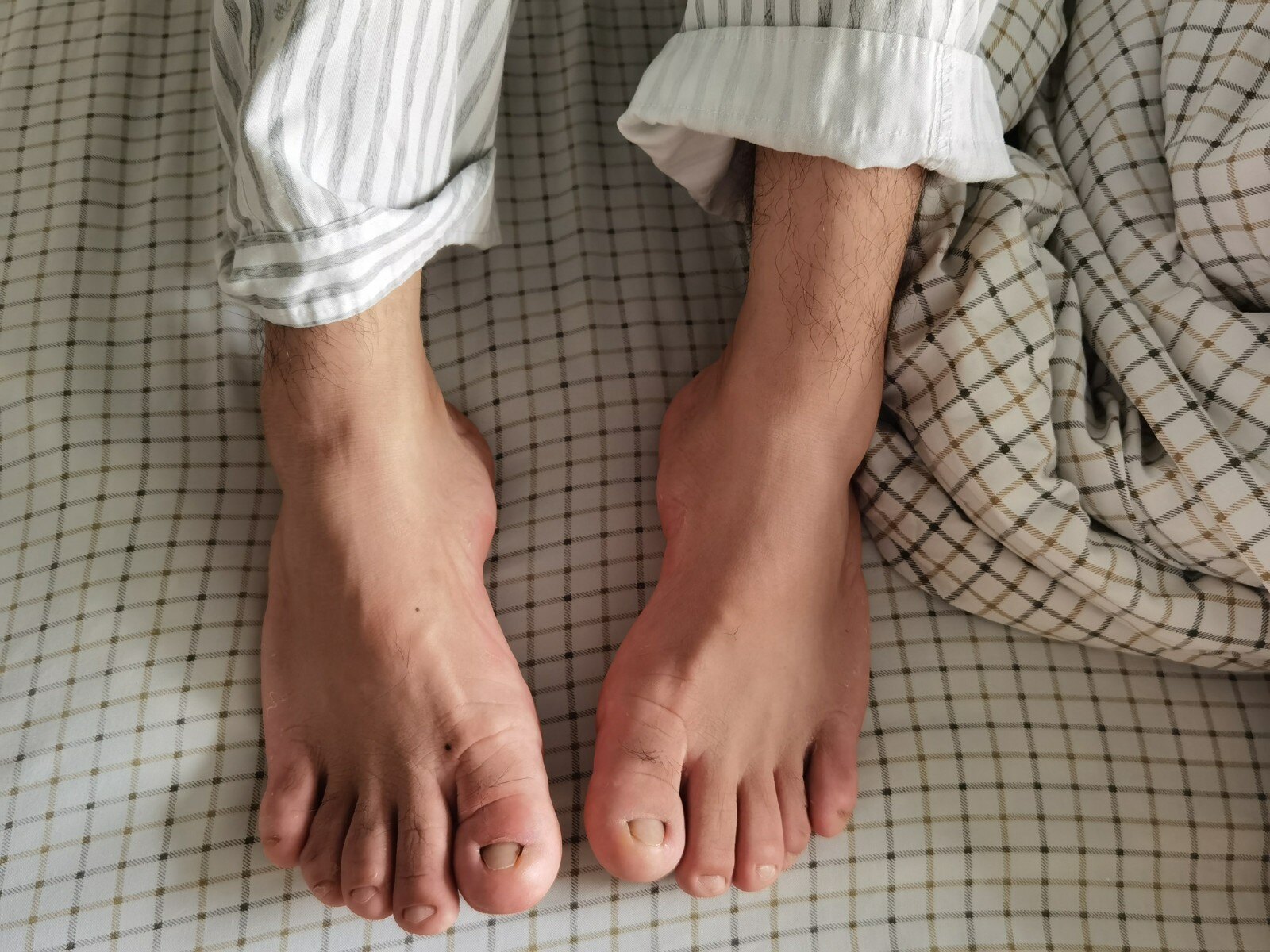 手足肥大要注意垂体肿瘤的可能_肢端肥大症_肢端肥大症症状表现 - 好