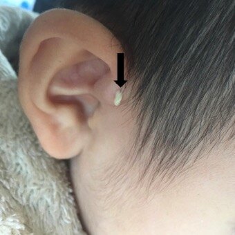 排脓的药膏有哪些 0YYBAGa3eMSAapIcAABiLjaji1I747.jpg?_ms_=f75b