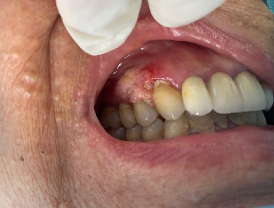 牙龈赘生物图片图片