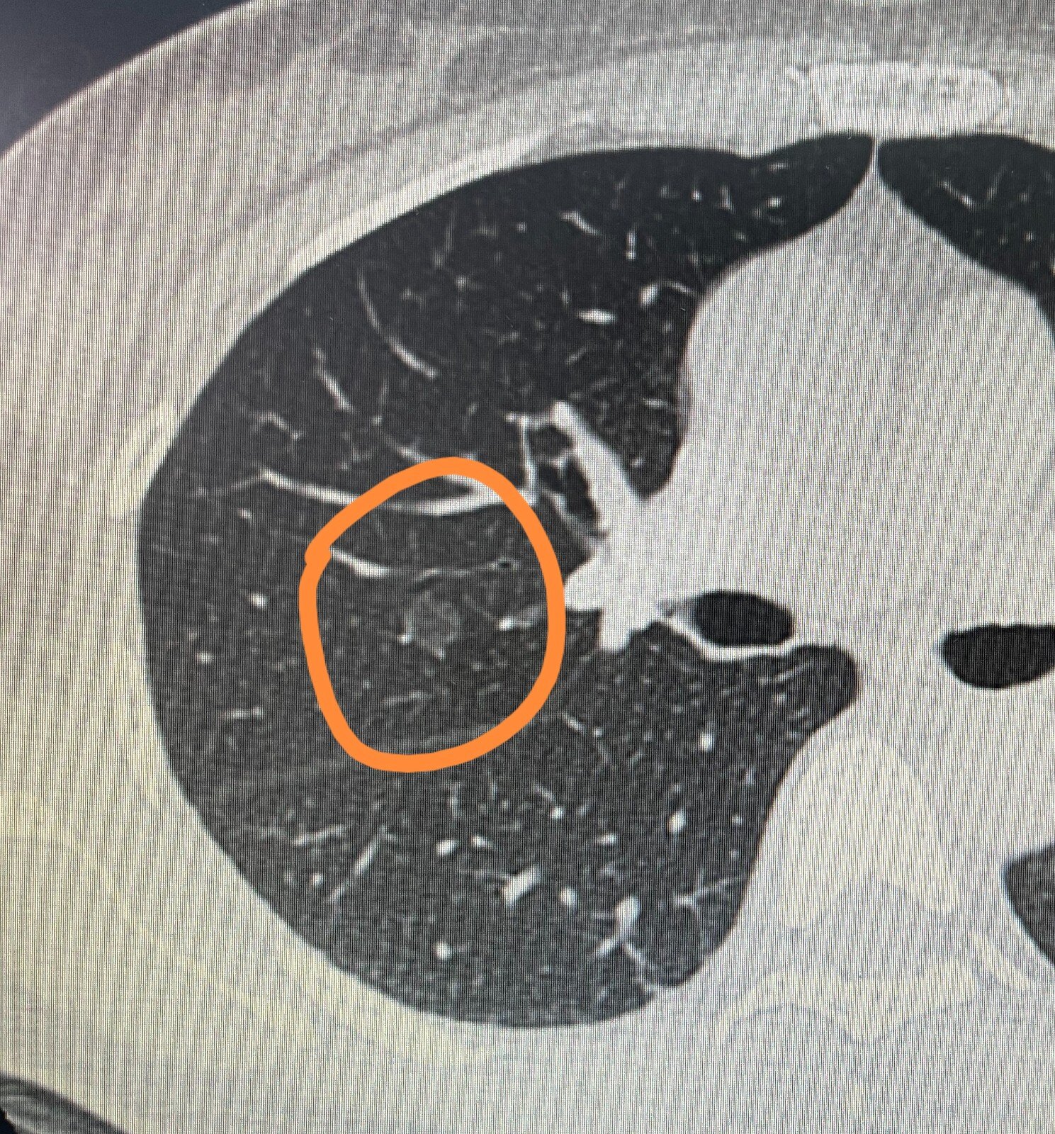 谈谈肺结节的前世今生_肺部结节_介绍_相关检查 - 好大夫在线